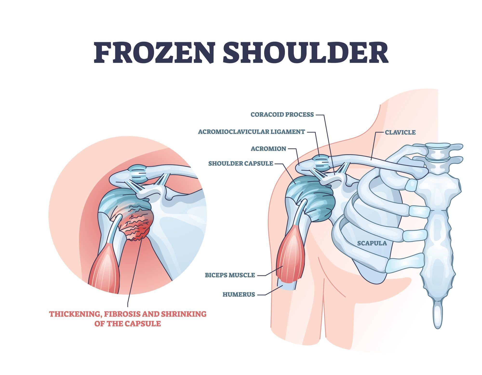 Anatomy diagram depicting the thickening, fibrosis, and shrinking of the shoulder capsule due to frozen shoulder.